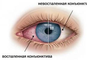 Обзор глазных капель для лечения разных типов конъюнктивитов